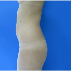18-24 year old woman treated with Brazilian Butt Lift before 3749159