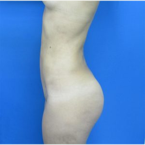 18-24 year old woman treated with Brazilian Butt Lift after 3749159