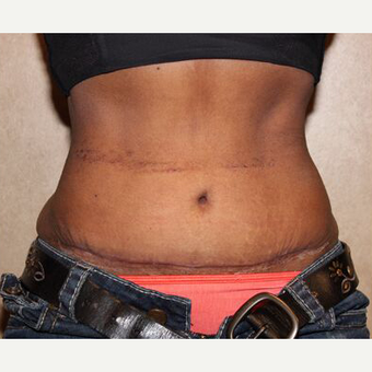 Tummy tuck with Liposuction after 3454559