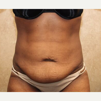 Tummy tuck with Liposuction before 3454559
