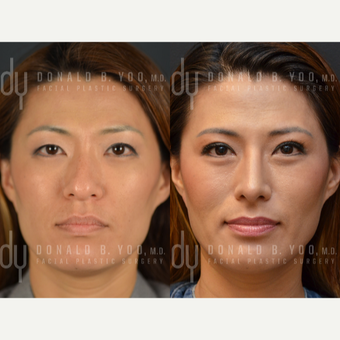 25-34 year old woman treated with Asian Rhinoplasty before 2990835