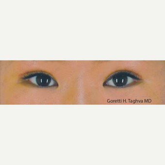 18-24 year old woman treated with Asian Eyelid Surgery after 3347004
