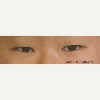 18-24 year old woman treated with Asian Eyelid Surgery before 3347004