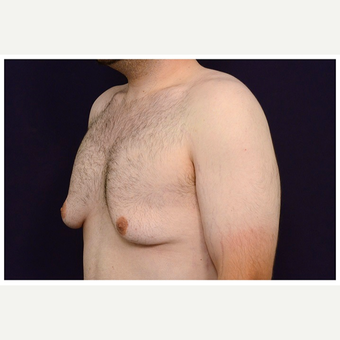 18-24 year old man treated with Male Breast Reduction before 3536527