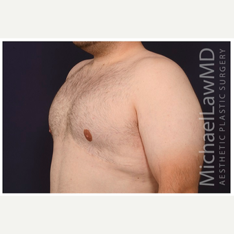 18-24 year old man treated with Male Breast Reduction after 3536527