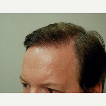 Hair Transplant after 3241381
