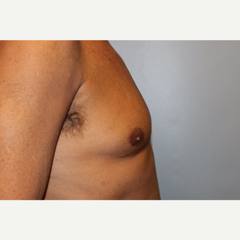 55-64 year old man treated with Male Breast Reduction before 3569499