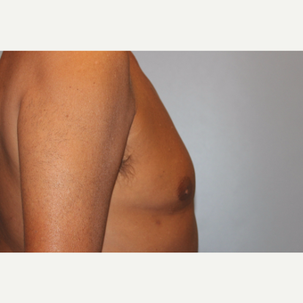 55-64 year old man treated with Male Breast Reduction after 3569499
