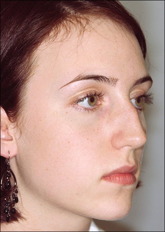 Rhinoplasty for a prominent hump before 1023198