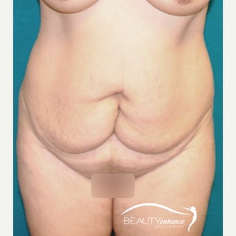 Extended Tummy Tuck before 2514550