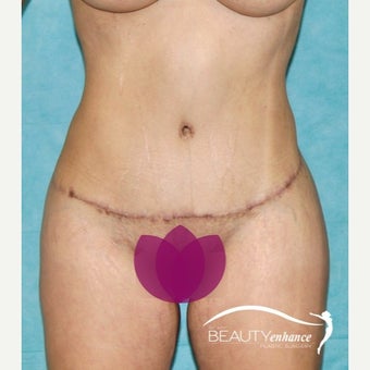 Extended Tummy Tuck after 2514550