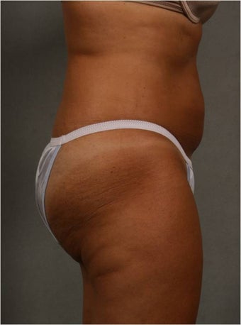 51 year old female with non surgical fat reduction via CoolSculpting of her abdomen after 1482615