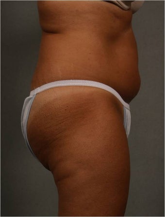 51 year old female with non surgical fat reduction via CoolSculpting of her abdomen before 1482615