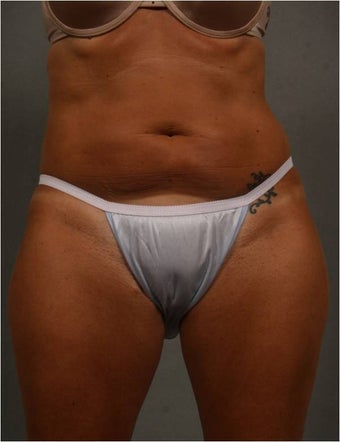 51 year old female with non surgical fat reduction via CoolSculpting of her abdomen 1482615