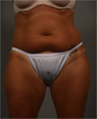 51 year old female with non surgical fat reduction via CoolSculpting of her abdomen 1482615