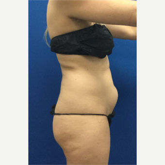 DUPL 25-34 year old woman treated with Slim Lipo before 3697152