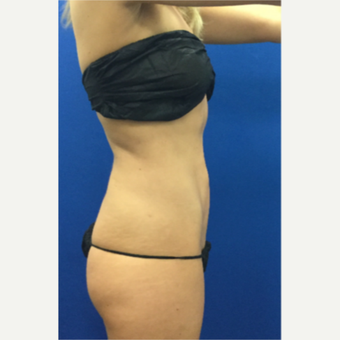 DUPL 25-34 year old woman treated with Slim Lipo after 3697152