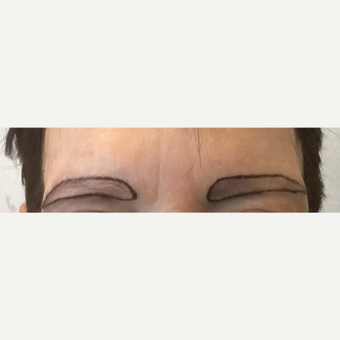 55-64 year old woman treated with NeoGraft before 3325830