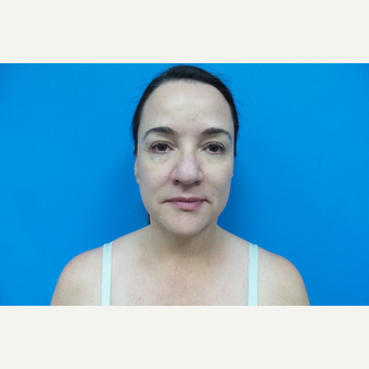 45-54 year old female treated with Rhinoplasty before 3376307