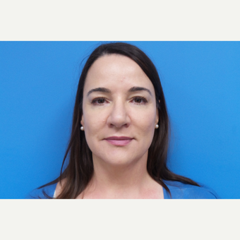 45-54 year old female treated with Rhinoplasty after 3376307