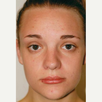 17 or under year old woman treated with Rhinoplasty after 3406166