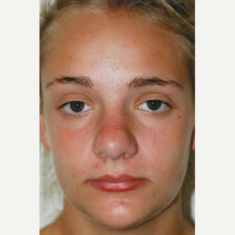 17 or under year old woman treated with Rhinoplasty before 3406166