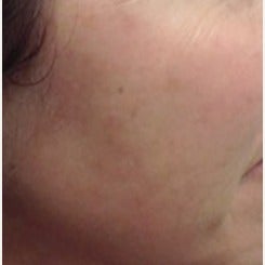 45-54 year old woman treated with Age Spots Treatment after 2442704