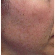 45-54 year old woman treated with Age Spots Treatment before 2442704
