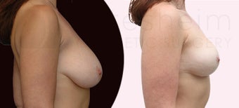 Small breast reduction before 1141929