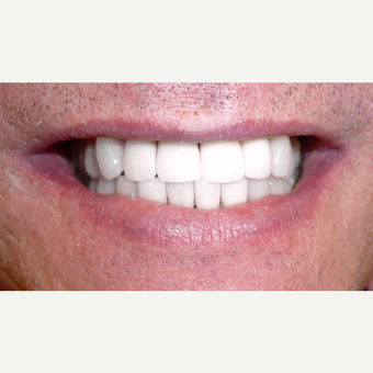 45-54 year old man treated with Smile Makeover after 3050327