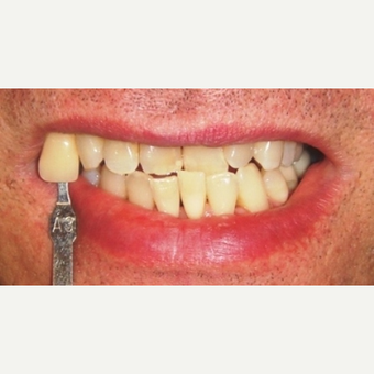 45-54 year old man treated with Smile Makeover before 3050327