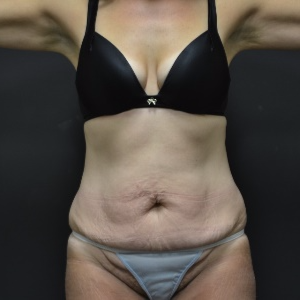 45-54 year old woman treated with Tummy Tuck before 3163236