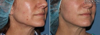35-44 year old woman treated with Inmode Fractora Forma before 2093843