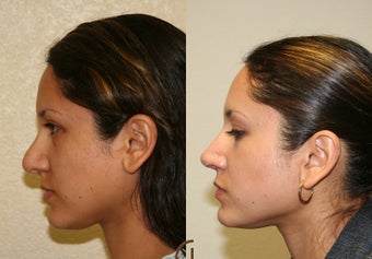 Revision Rhinoplasty before 252418