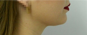 22 year old woman treated with Liposuction of the Neck after 3293594