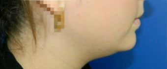 22 year old woman treated with Liposuction of the Neck before 3293594