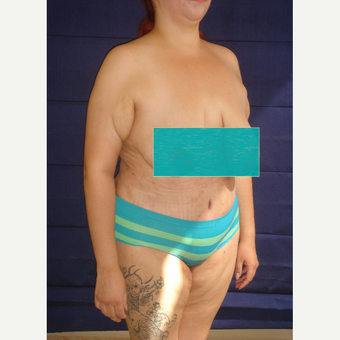 34 year old woman treated with Tummy Tuck after 3738136