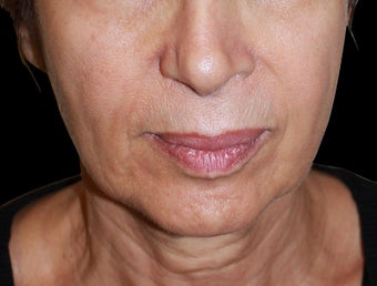Face lift with neck lift before 1218230