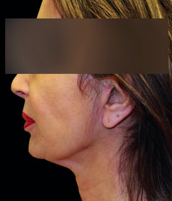 Face lift with neck lift 1218230