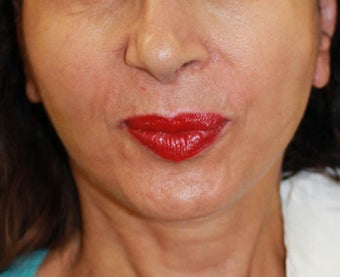 Face lift with neck lift after 1218230