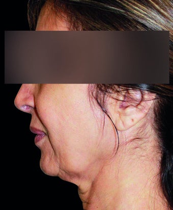 Face lift with neck lift 1218230