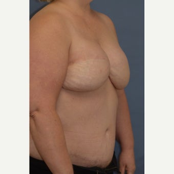 Delayed Breast Reconstruction with Free Ms TRAM Flap 1858950