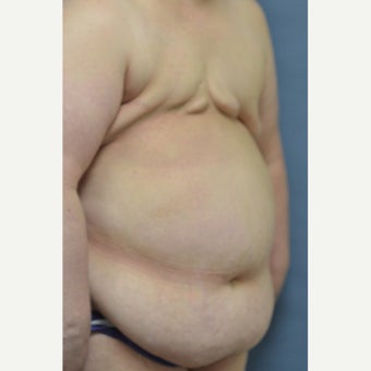 Delayed Breast Reconstruction with Free Ms TRAM Flap 1858950