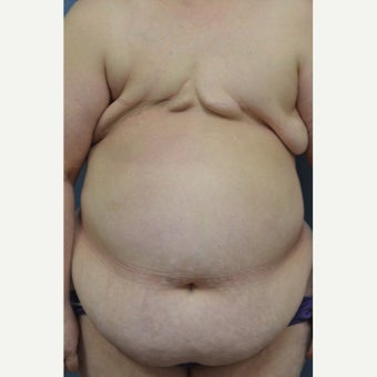 Delayed Breast Reconstruction with Free Ms TRAM Flap before 1858950