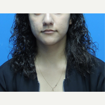 18-24 year old woman treated with Rhinoplasty before 3704503