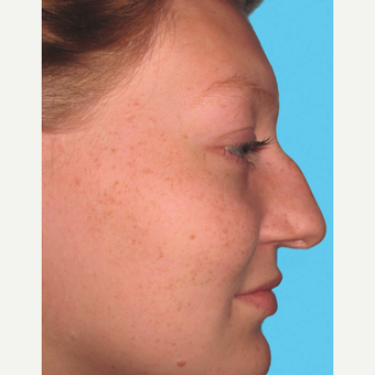 Rhinoplasty before 3814260
