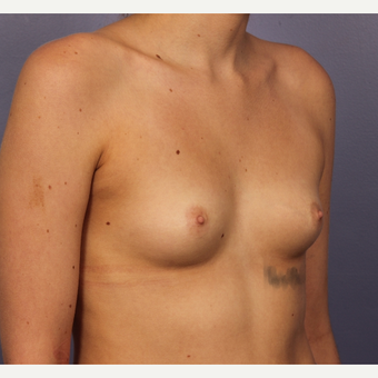 18-24 year old woman treated with Breast Augmentation before 3494790