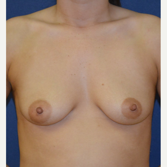 18-24 year old woman treated with Breast Augmentation before 3092558