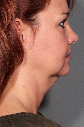 Necklift (Platysmaplasty) before 1275018