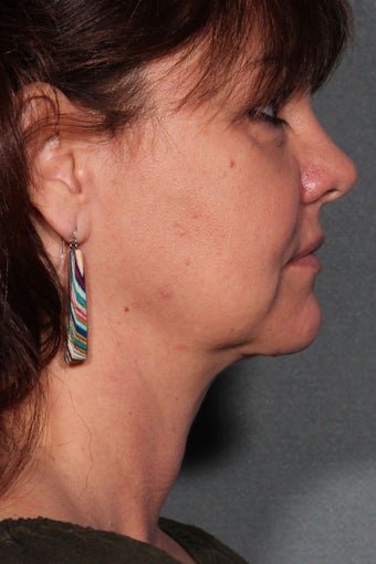 Necklift (Platysmaplasty) after 1275018